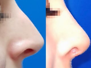 Rhinoplastika - MUDr. Radan Vidura, Ph.D. - RVmedCentrum