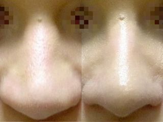 Rhinoplastika - MUDr. Radan Vidura, Ph.D. - RVmedCentrum