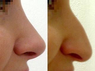 Rhinoplastika - MUDr. Radan Vidura, Ph.D. - RVmedCentrum
