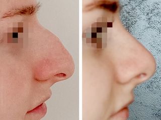 Rhinoplastika - MUDr. Radan Vidura, Ph.D. - RVmedCentrum