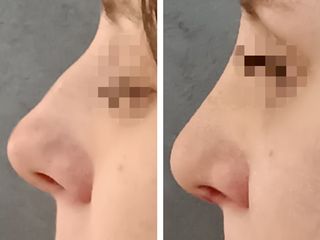 Rhinoplastika - MUDr. Radan Vidura, Ph.D. - RVmedCentrum