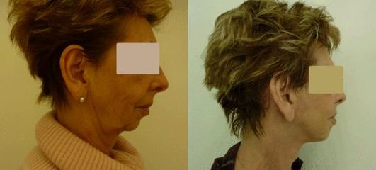 facelift 3a