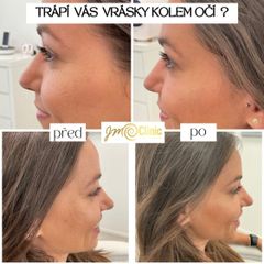Odstranění mimických vrásek - JM Clinic