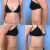 Sešití diastázy, operace kýly a abdominoplastika - Dr. Martin Chorvát, Vinohrady