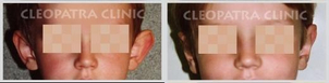 Otoplastika: před/po 
