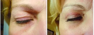 Neinvazivní blefaroplastika