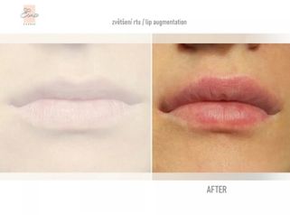 Lip augmentation